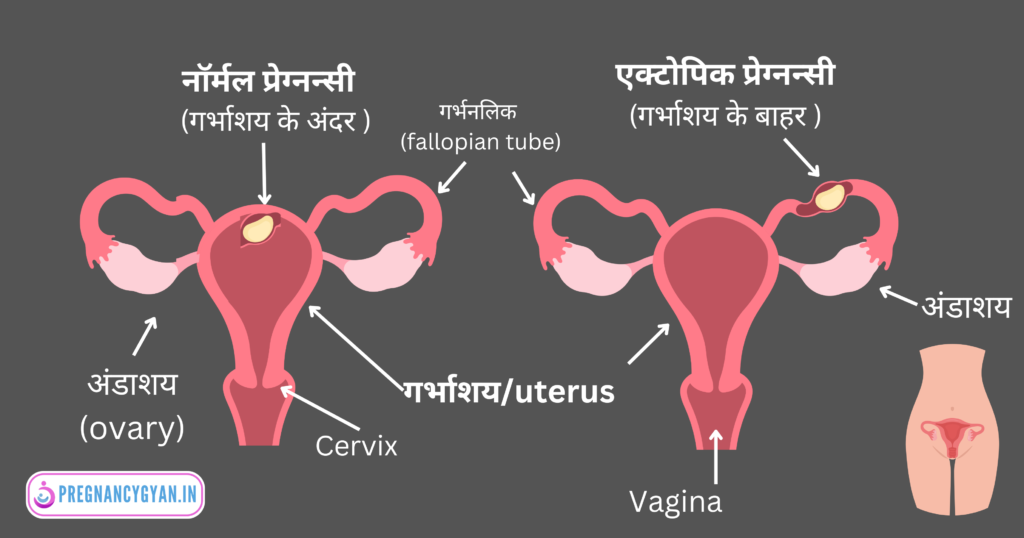 what is ectopic pregnancy?